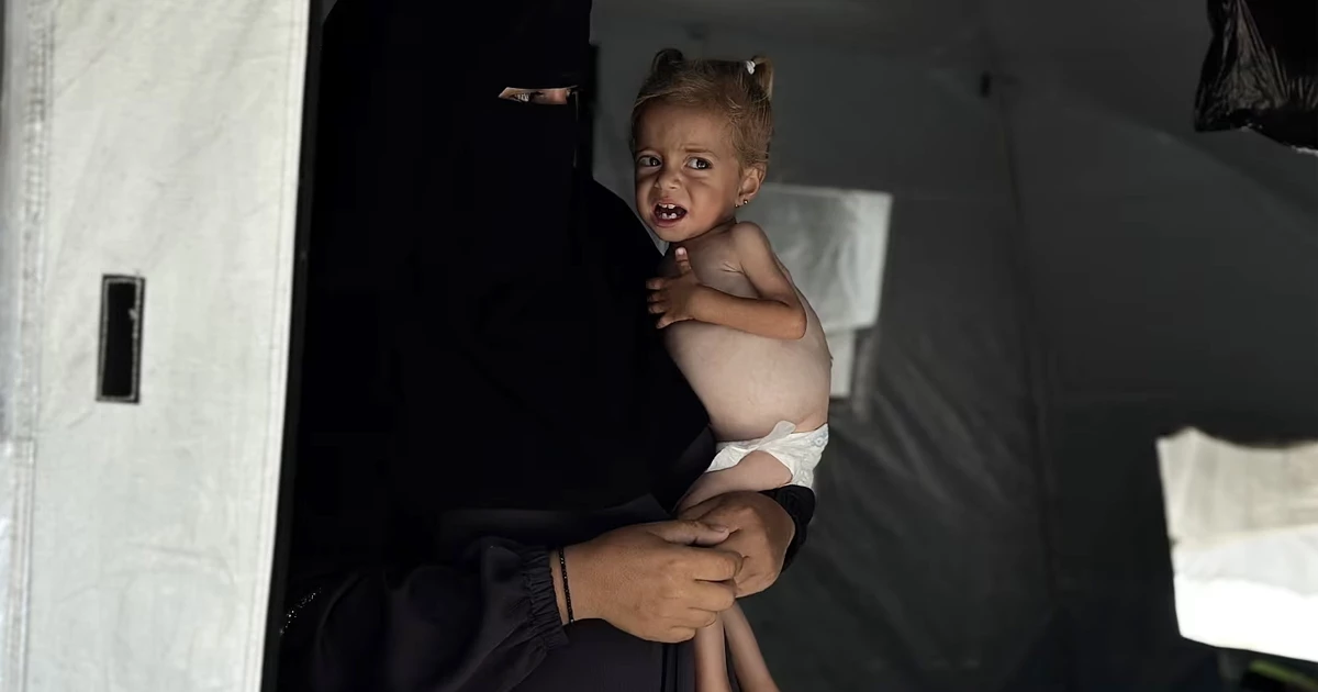 খাবারের অভাবে হাড্ডি-চর্মসার হয়ে গেছে গাজার শিশুরা: চিকিৎসক