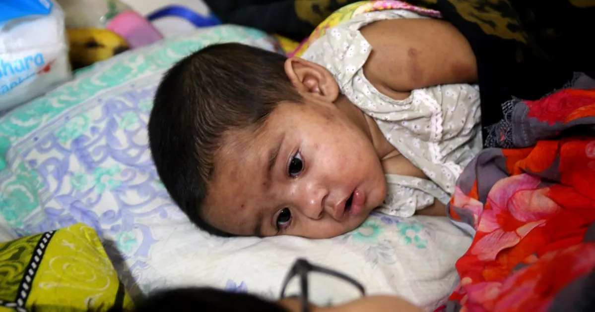 হাম ও হামের উপসর্গ নিয়ে আরও ৮ শিশুর মৃত্যু, ঢাকাতেই ৫