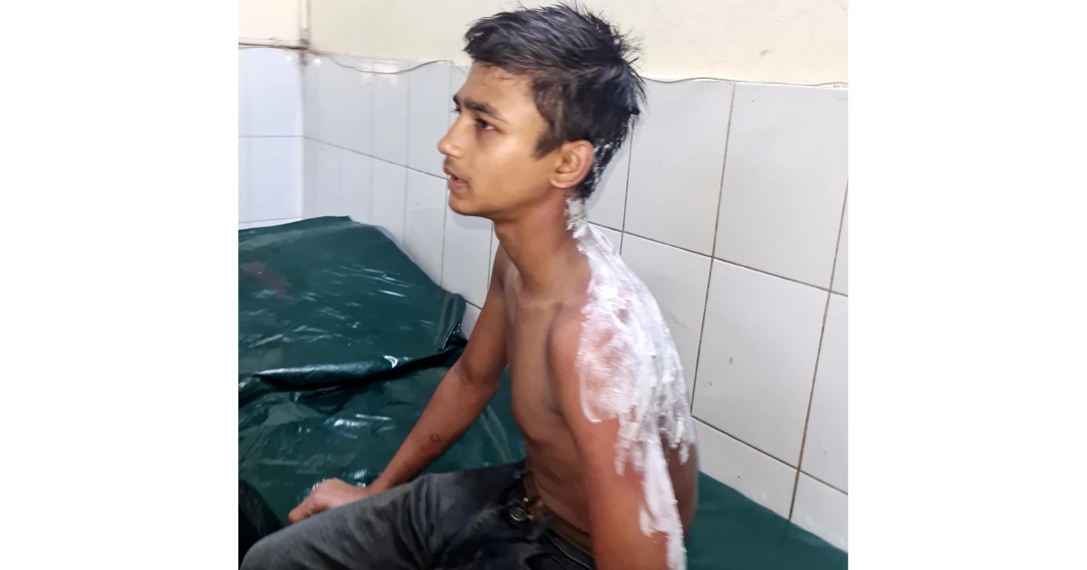 কুমিল্লায় বাবুর্চির ঢেলে দেওয়া ভাতের মাড়ে পুড়ল কিশোরের শরীর