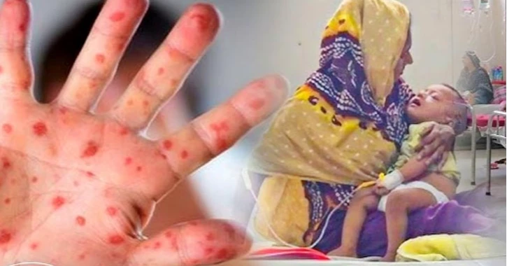 ঝিনাইদহে হাম ও উপসর্গ নিয়ে দেড় মাসে হাসপাতালে ভর্তি ১০৫, মৃত্যু নেই