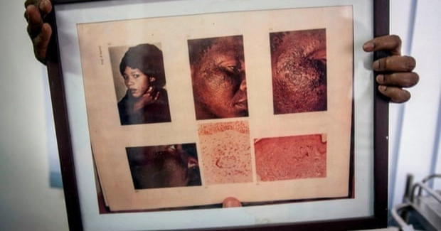 আফ্রিকান নারীদের শরীরে ক্যানসার ছড়াচ্ছে ত্বক ফর্সাকারী পণ্য