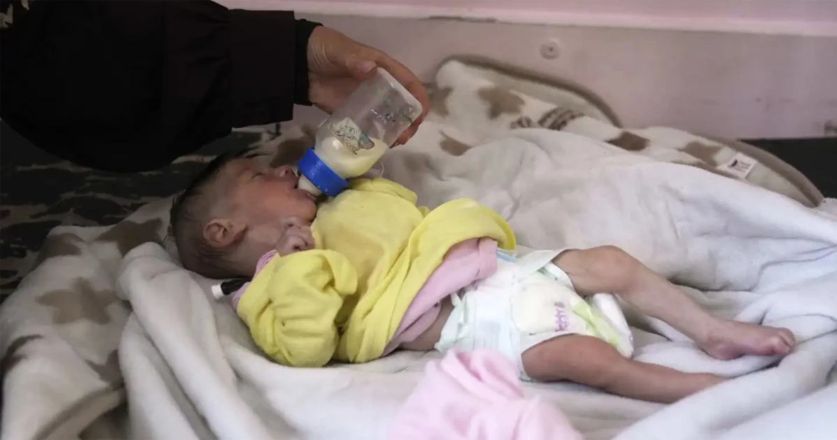 ক্ষুধার রাজ্যে পরিণত হয়েছে গাজা, উপচে পড়ছে হাসপাতাল