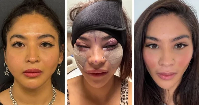 A facelift at 28? Why young people are turning to plastic surgery