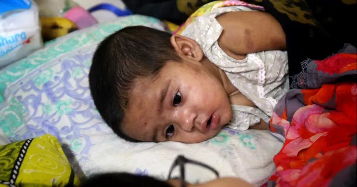 Bangladesh records 4 more deaths from measles, similar symptoms