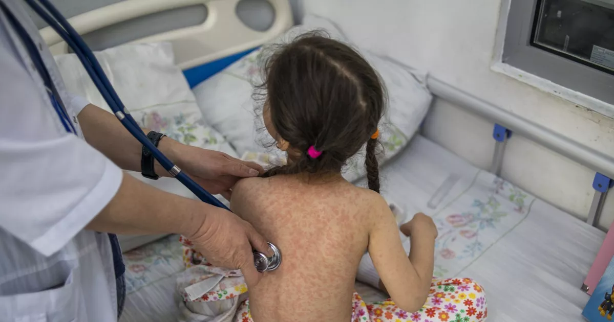Measles cases rise in Sylhet; 12 children hospitalised