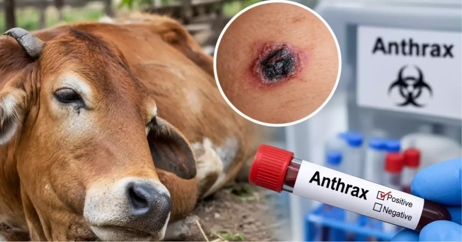 Anthrax detected in 3 of 11 people tested in Rangpur