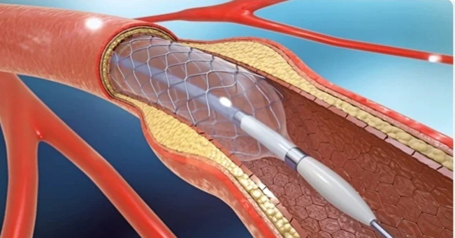 Budget FY27: Tax cuts on heart stents, dialysis equipment to lower treatment costs