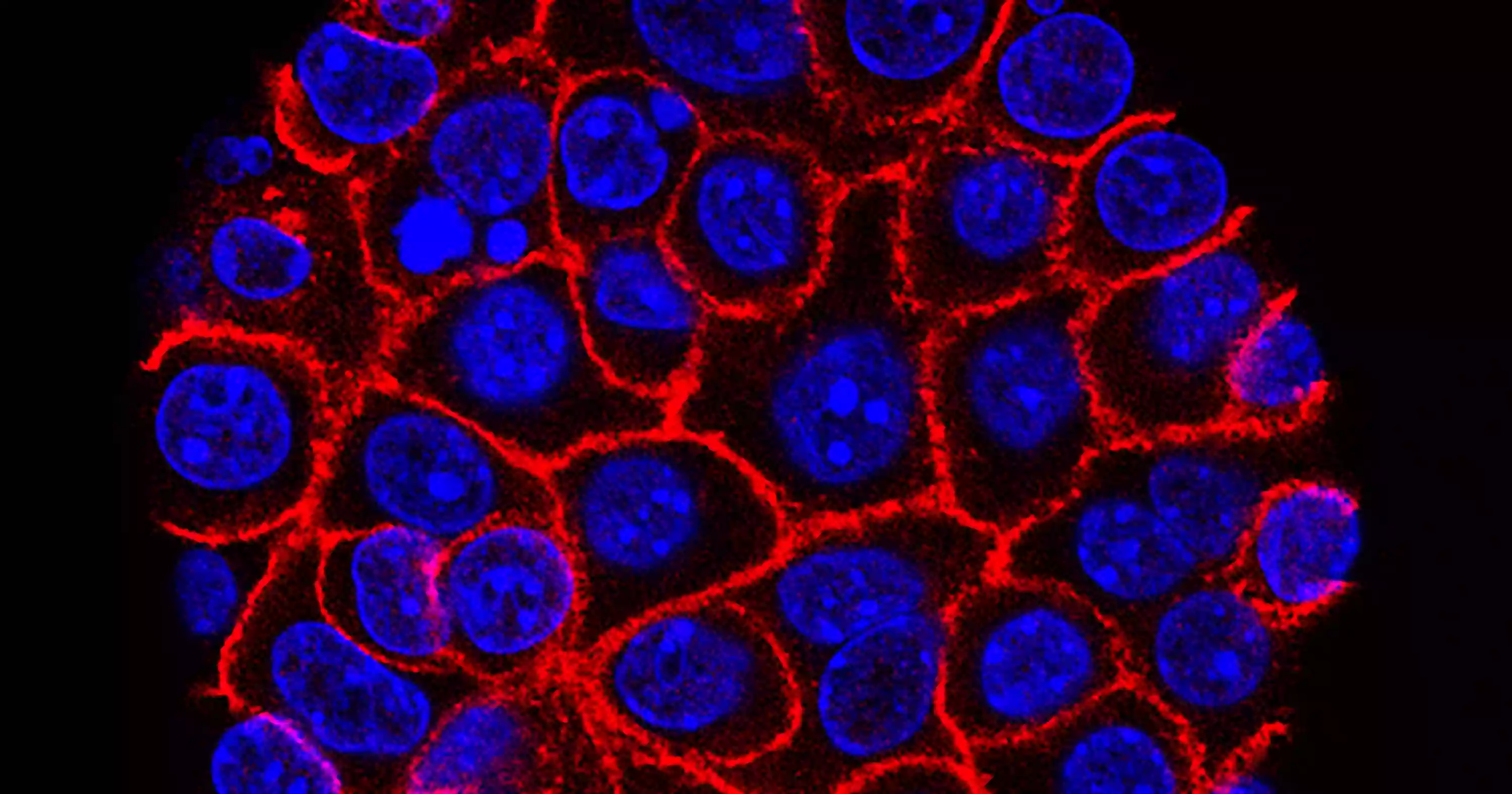 New drug offers hope for advanced pancreatic cancer treatment