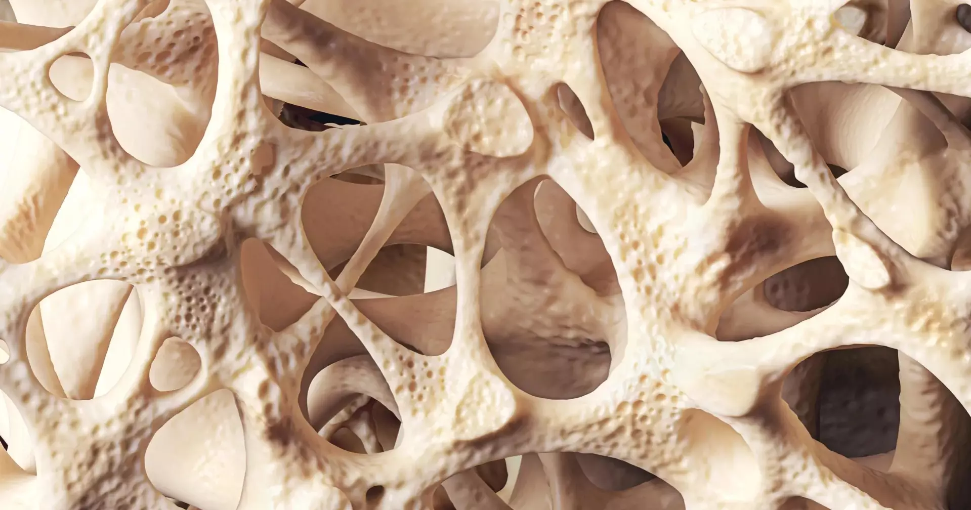 Osteopenia quietly weakening bones of millions worldwide