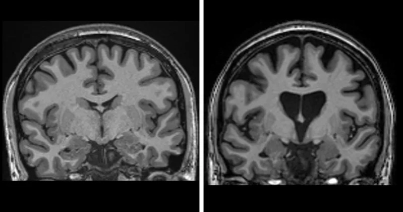 UK researchers achieve first successful treatment for Huntington’s disease