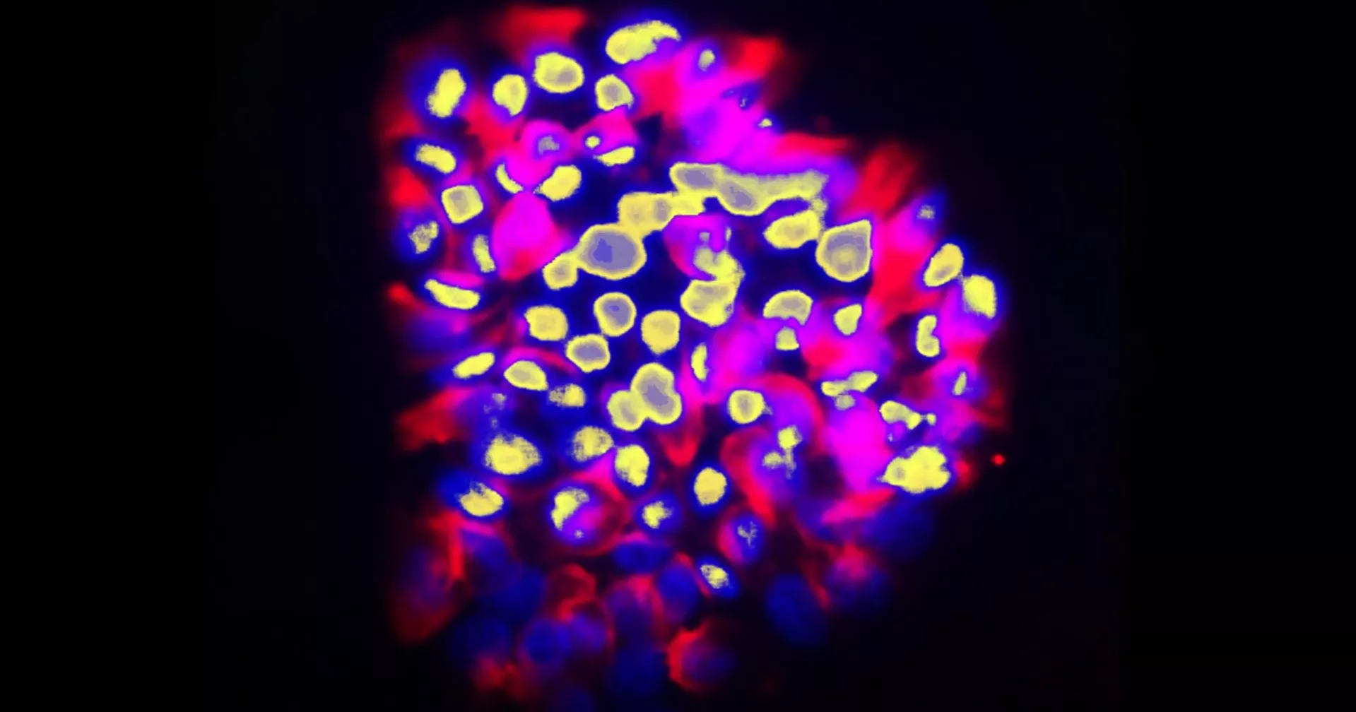 New AI tool shows strong accuracy in predicting cancer spread