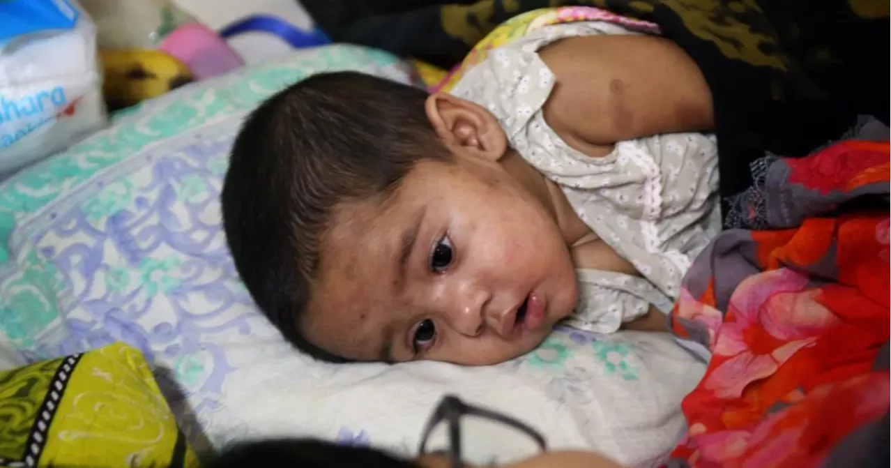 5 suspected measles patients die in 24 hours: DGHS