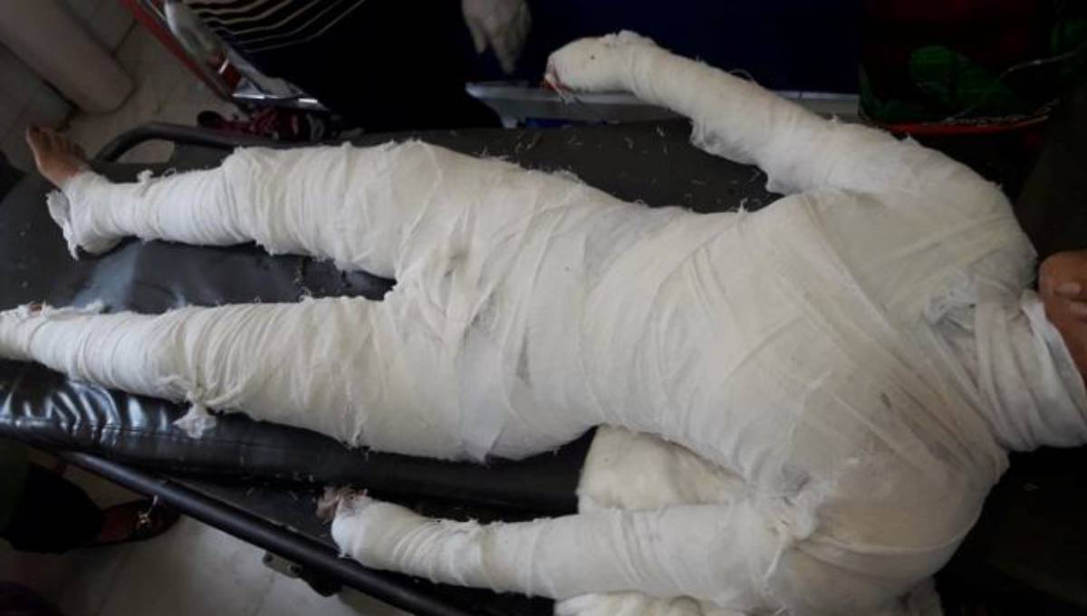 Female madrasa student set on fire at exam centre in Feni