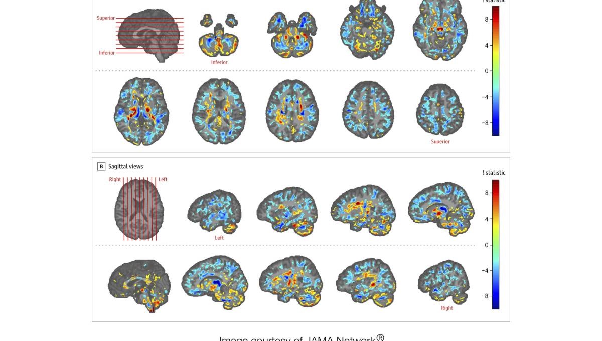 Diplomats' brain scans show differences, add to Cuba mystery