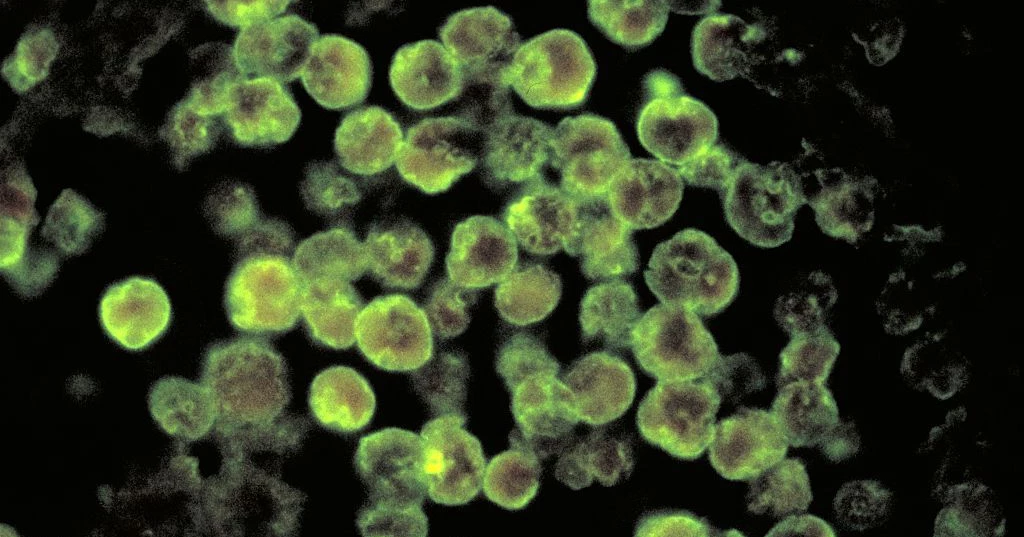 Brain-eating amoeba symptoms