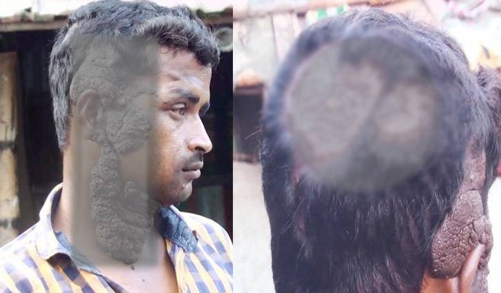 Satkhira van-puller attacked by rare disease