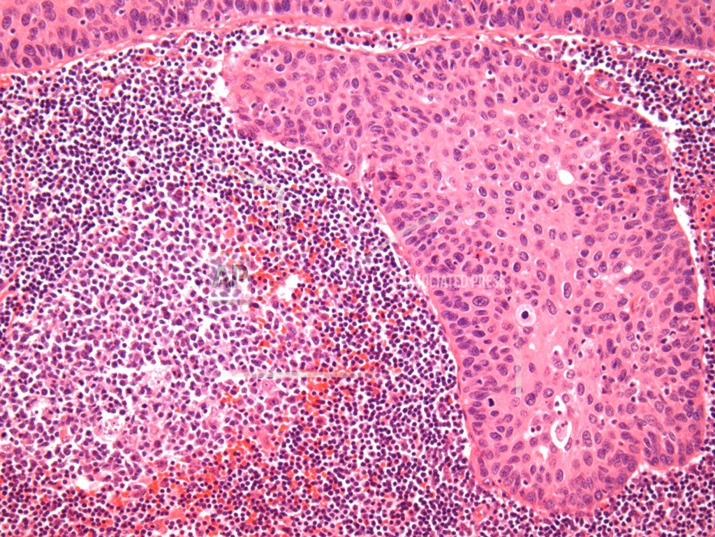 More deaths seen for less invasive cervical cancer surgery